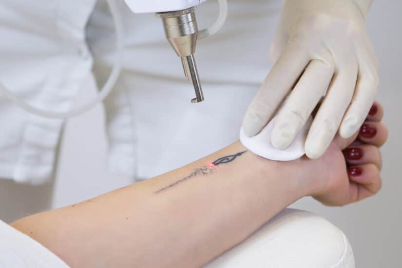 Photo of tattoo removal process